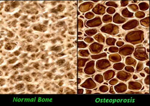 Healthy dense bone on the left, and fragile unhealthy [osteoporotic]  bone on the right.